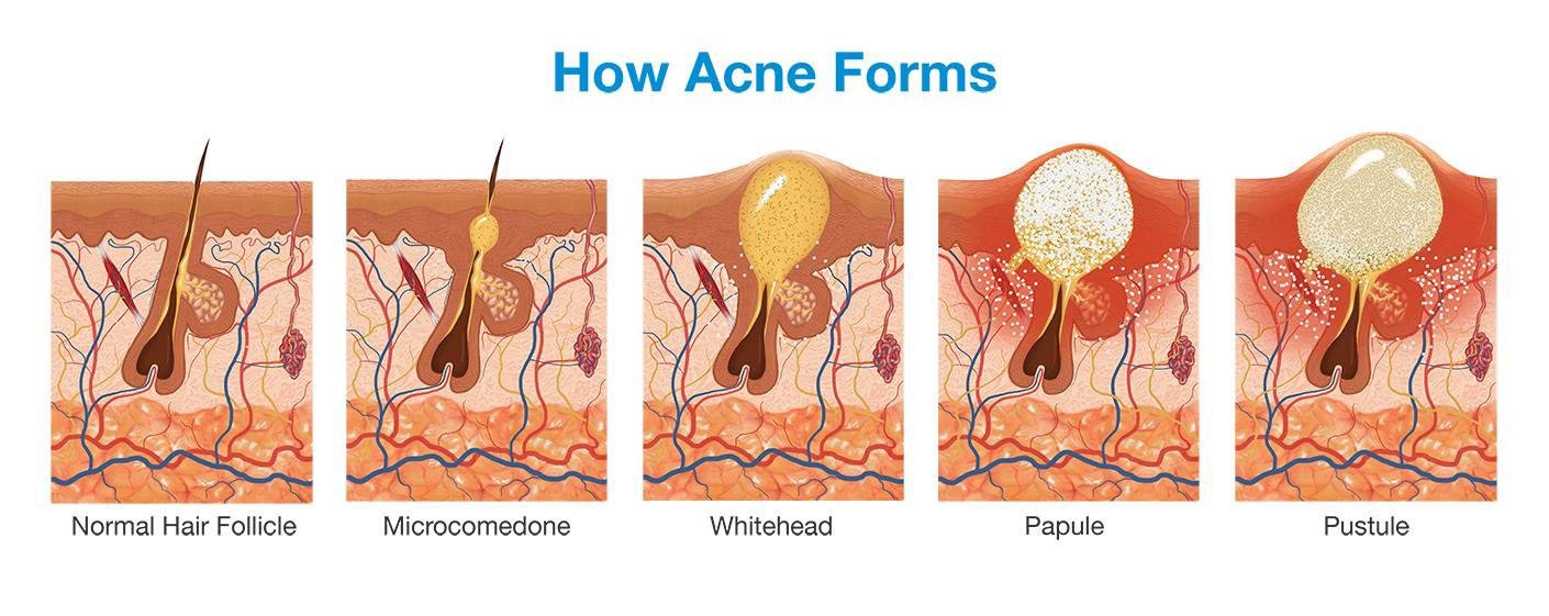 ACNE PRONE SKIN